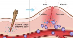Inflammation is the body's protective response against infection.